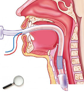 Sonde d'intubation