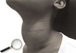 Goitre_augmentation de volume de la thyroïde