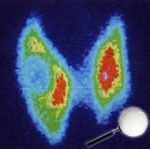 Scintigraphie de la thyroïde: Cancer de la Thyroïde